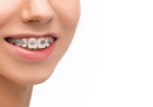 Your Perfect Smile Awaits: Tips for Choosing Adult Braces That Actually Work