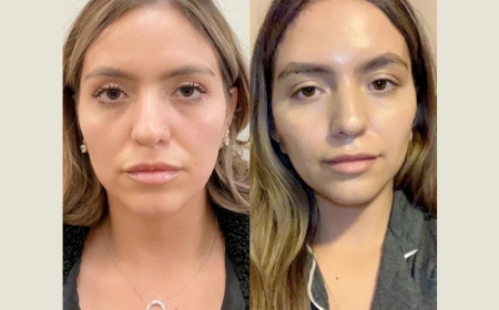 Thread Lift Myths Debunked by the Best Plastic Surgeon in Dubai