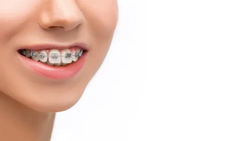 Your Perfect Smile Awaits: Tips for Choosing Adult Braces That Actually Work
