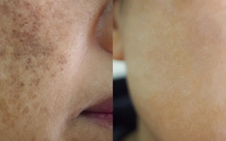 How Pigmentation Treatment Can Restore Your Skin’s Natural Glow