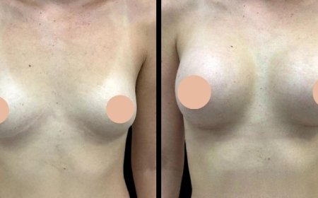 Best Breast Augmentation Surgeons in Dubai: How to Prepare for Your Breast Augmentation Surgery