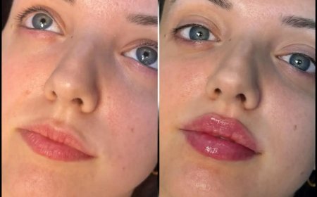 Safe and Expert Care with the Best Doctors in Dubai for Fillers