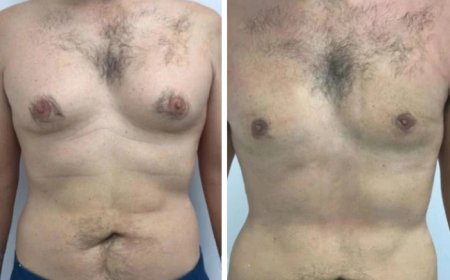 Post-Operative Care for Gynecomastia in Dubai: Best Practices