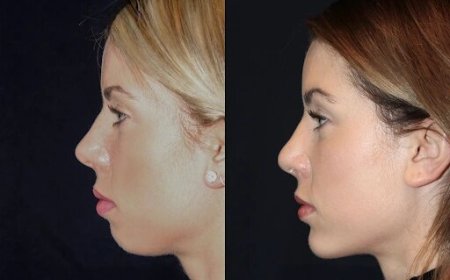 Best Doctors in dubai for Chin Fillers: How to Maintain Your Youthful Chin Definition