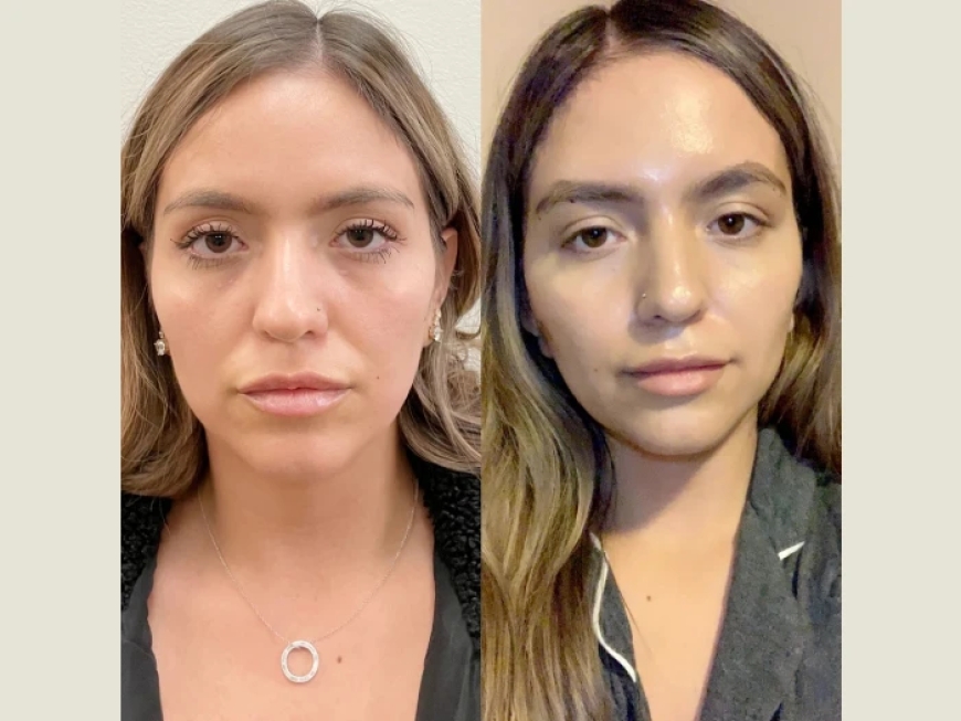Thread Lift Myths Debunked by the Best Plastic Surgeon in Dubai