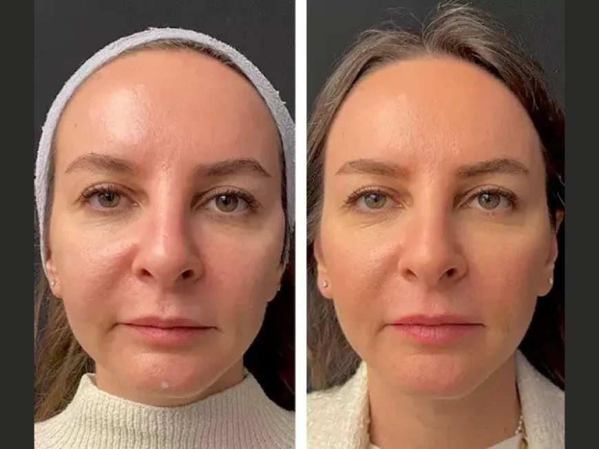 What to Expect from Your First Mesotherapy Session with the Best Plastic Surgeon in Dubai