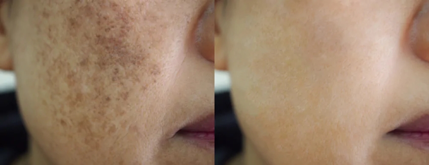 How Pigmentation Treatment Can Restore Your Skin’s Natural Glow