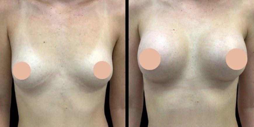 Best Breast Augmentation Surgeons in Dubai: How to Prepare for Your Breast Augmentation Surgery