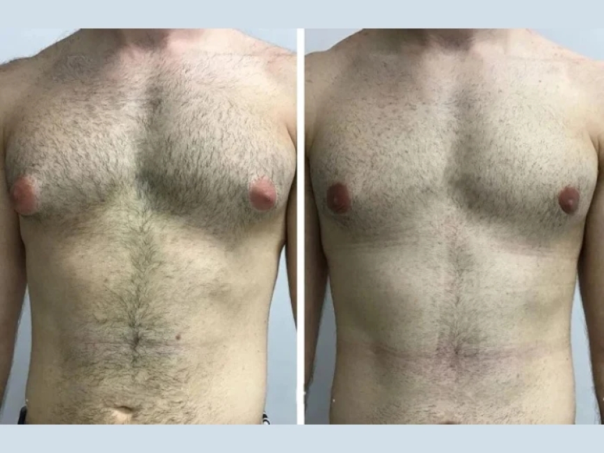 Common Myths Debunked by the Best Gynecomastia Surgeons in Dubai