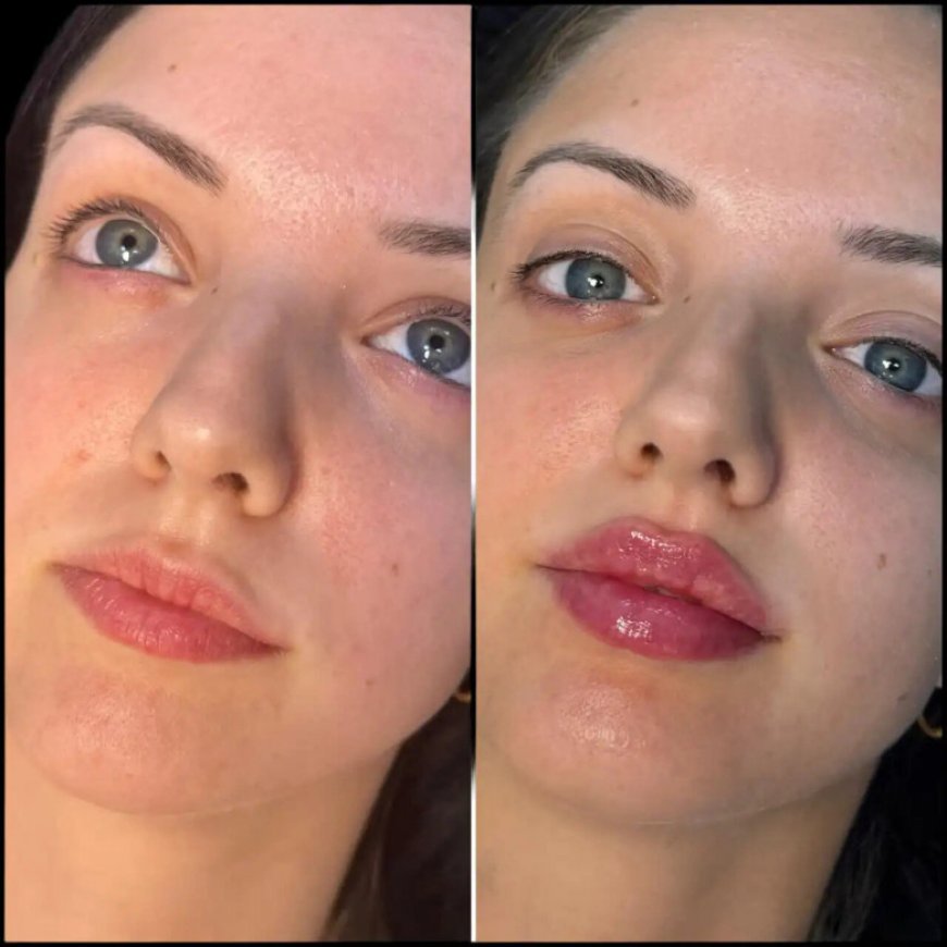 Safe and Expert Care with the Best Doctors in Dubai for Fillers
