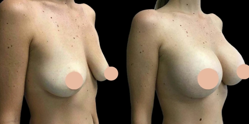 What Makes Breast Augmentation in Dubai So Popular?