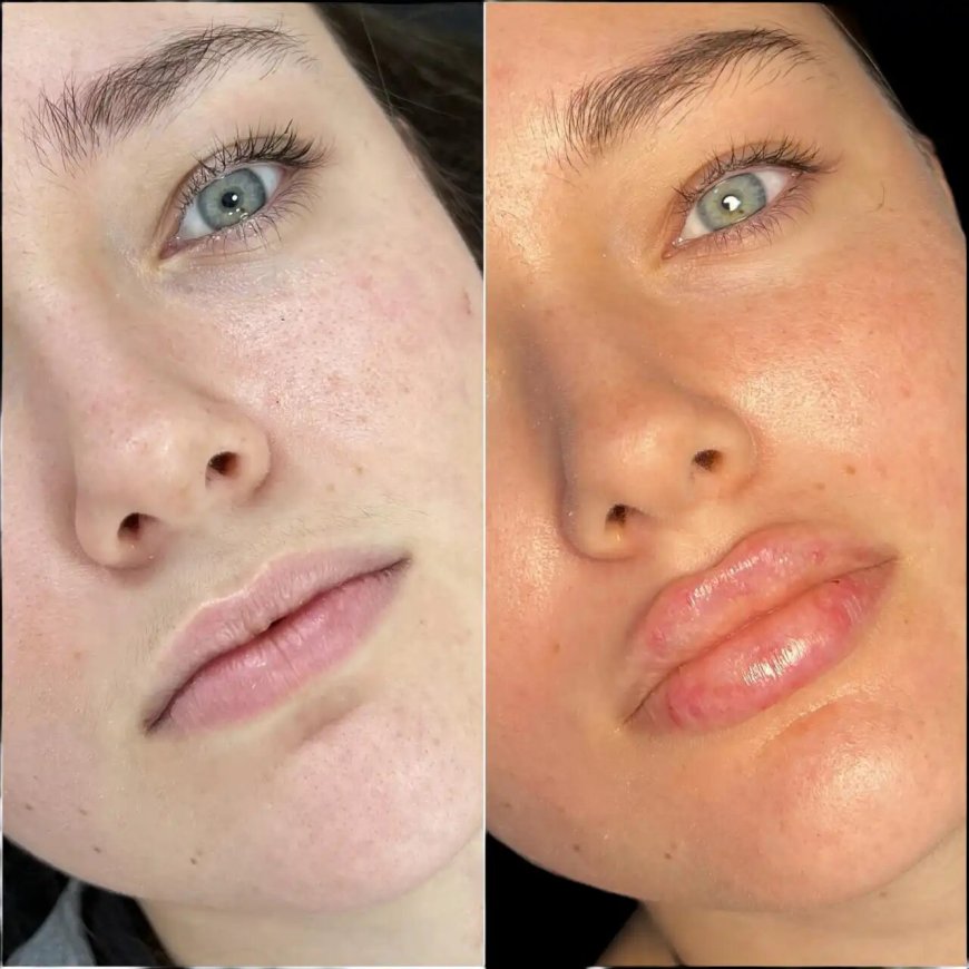 Best Doctors in dubai for Fillers: Safe Practices and Quality Standards