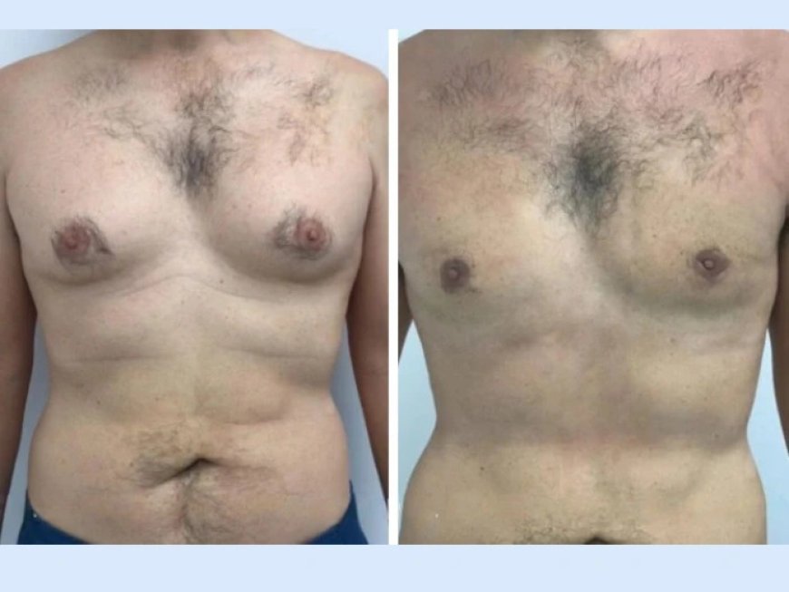 Post-Operative Care for Gynecomastia in Dubai: Best Practices
