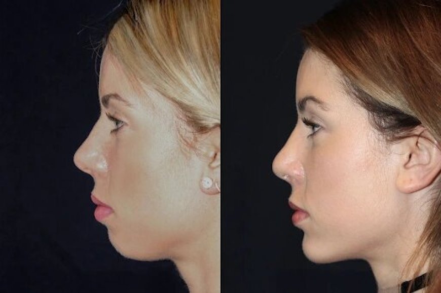 Best Doctors in dubai for Chin Fillers: How to Maintain Your Youthful Chin Definition