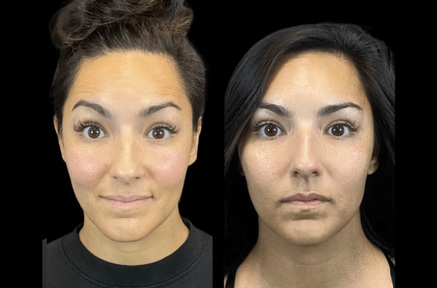 Why First-Timers Should Trust Only the Best Doctors in dubai for Botox