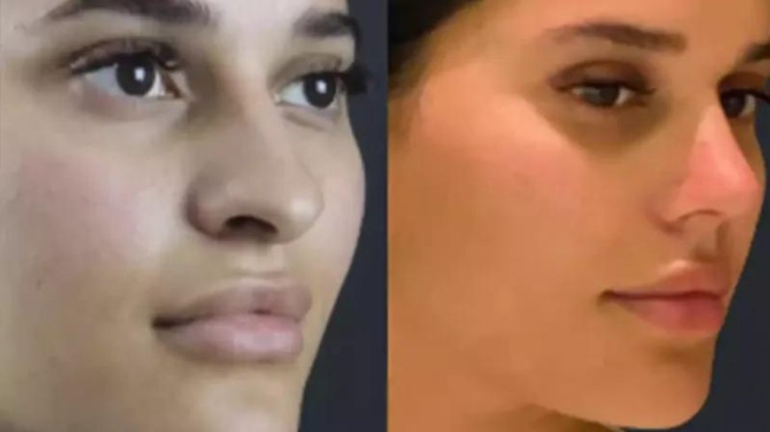 Rhinoplasty in Dubai: Best Practices for Long-Term Results
