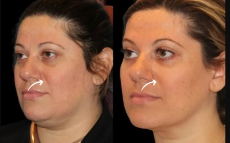 Top 5 Benefits of Sculptra Fillers at Dubai’s Best Aesthetic Clinic