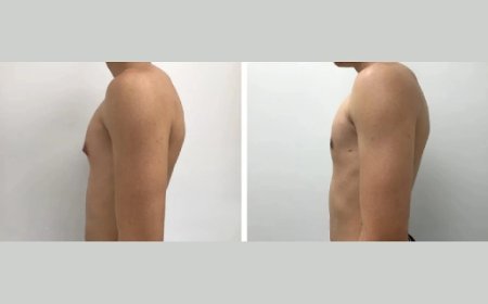 Gynecomastia Surgery in Dubai: How to Choose the Best Surgeon for Your Needs