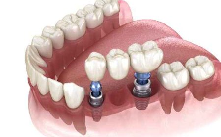 Enhancing Implant Outcomes with Strategic Bone Grafting