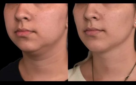 Best Double chin removal Surgeons in Dubai on Post-Surgery Massage