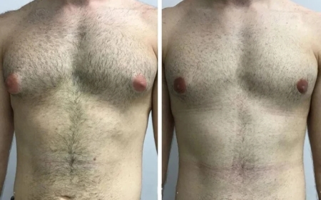 Understanding Male Breast Reduction with the Best Doctors in Dubai