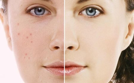 Why Laser Skin Lightening Is Ideal for Uneven Tone & Pigmentation