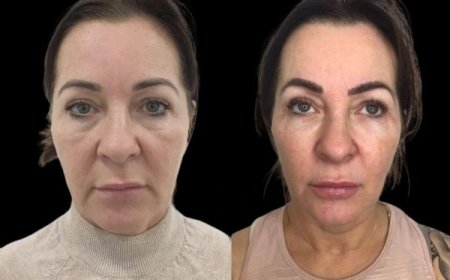 Best Plastic Surgeon in Dubai for Profhilo: Cost, Benefits, and Results Explained