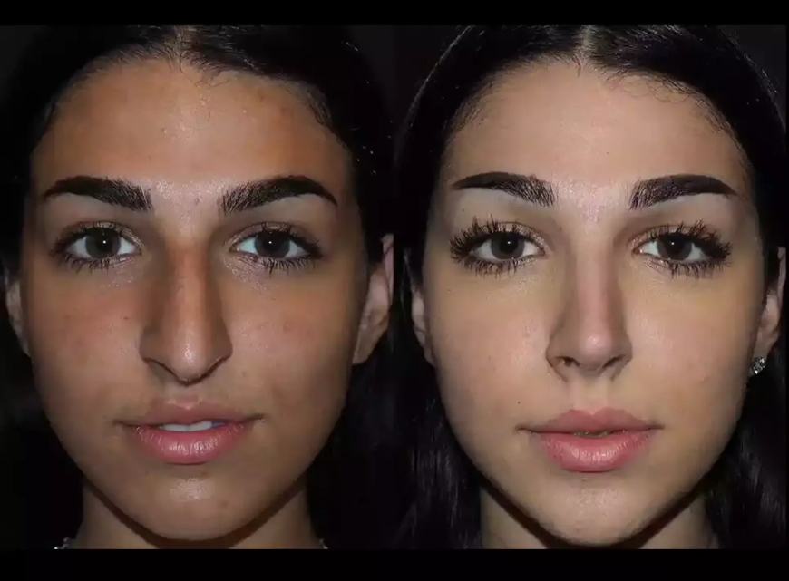 How Septoplasty in Dubai Improves Quality of Life