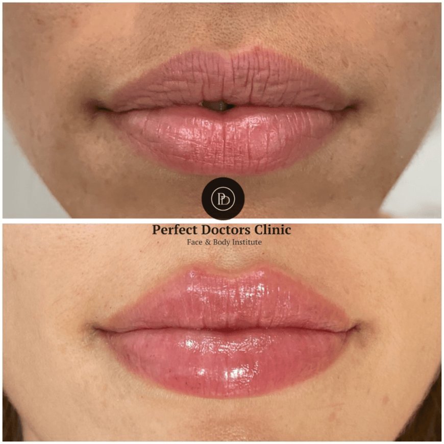 How Dermal Fillers Help with Skin Hydration at the Best Aesthetic Clinic in Dubai