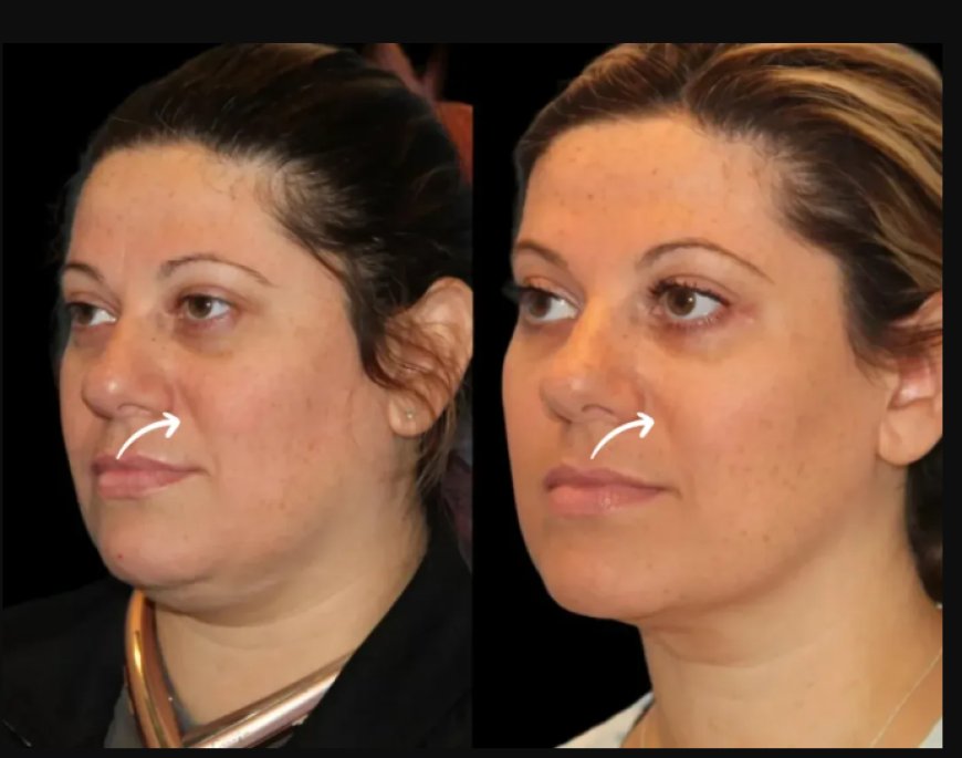 Top 5 Benefits of Sculptra Fillers at Dubai’s Best Aesthetic Clinic