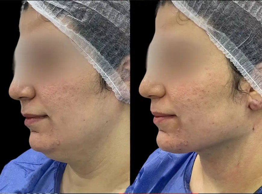 Best Aesthetic Clinics in dubai for Chin Fillers: Non-Surgical Chin Augmentation Experts
