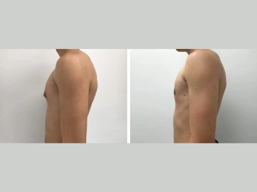 Gynecomastia Surgery in Dubai: How to Choose the Best Surgeon for Your Needs