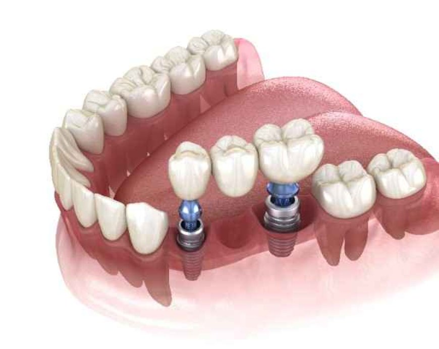 Enhancing Implant Outcomes with Strategic Bone Grafting