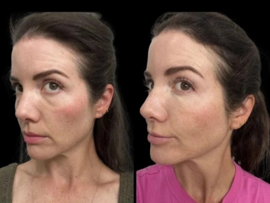 Dark Circles Treatments in Dubai: What You Should Know About Home Remedies