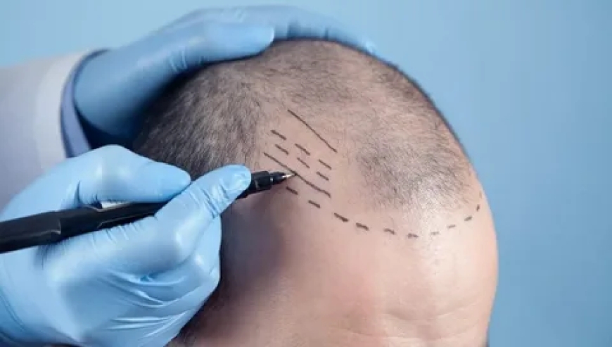 Regain Your Confidence: The Ultimate Guide to Hair Loss Treatment in Lahore