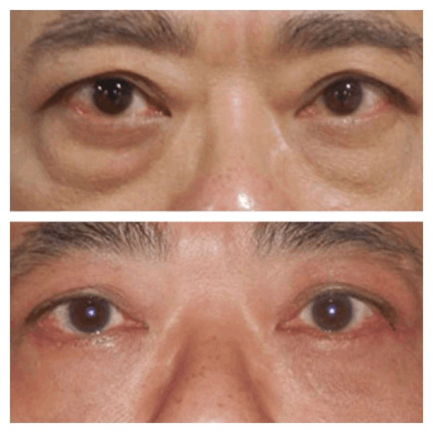 What Sets Apart the Best Eye bag removal Surgeons in Dubai from Others?