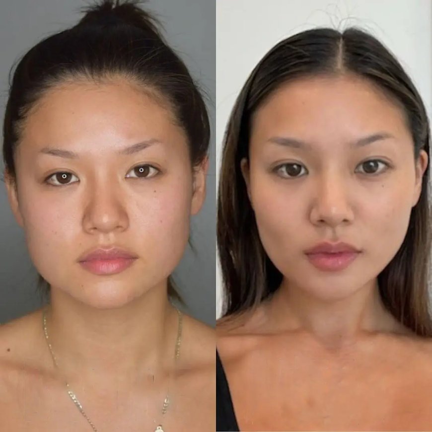 Post-Treatment Care from the Best Buccal fat removal Surgeons in Dubai