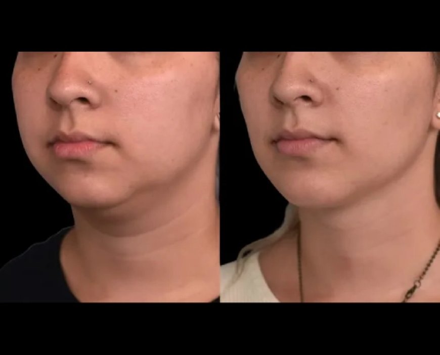 Best Double chin removal Surgeons in Dubai on Post-Surgery Massage