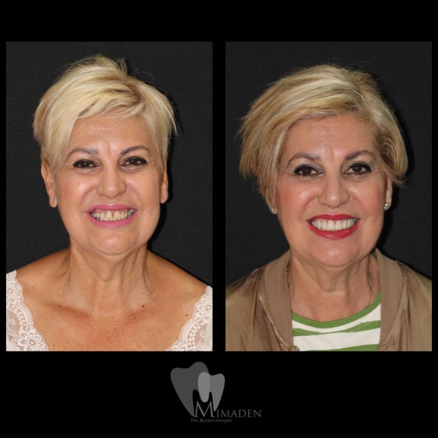 Blanqueamiento Dental en Hospitalet de Llobregat Dientes Más Blancos y Brillantes