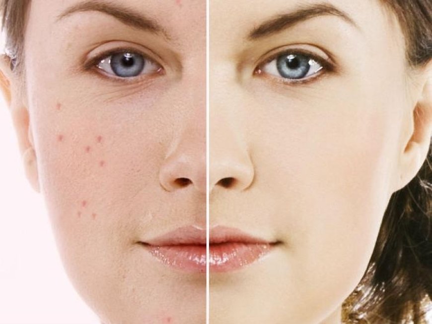 Why Laser Skin Lightening Is Ideal for Uneven Tone & Pigmentation