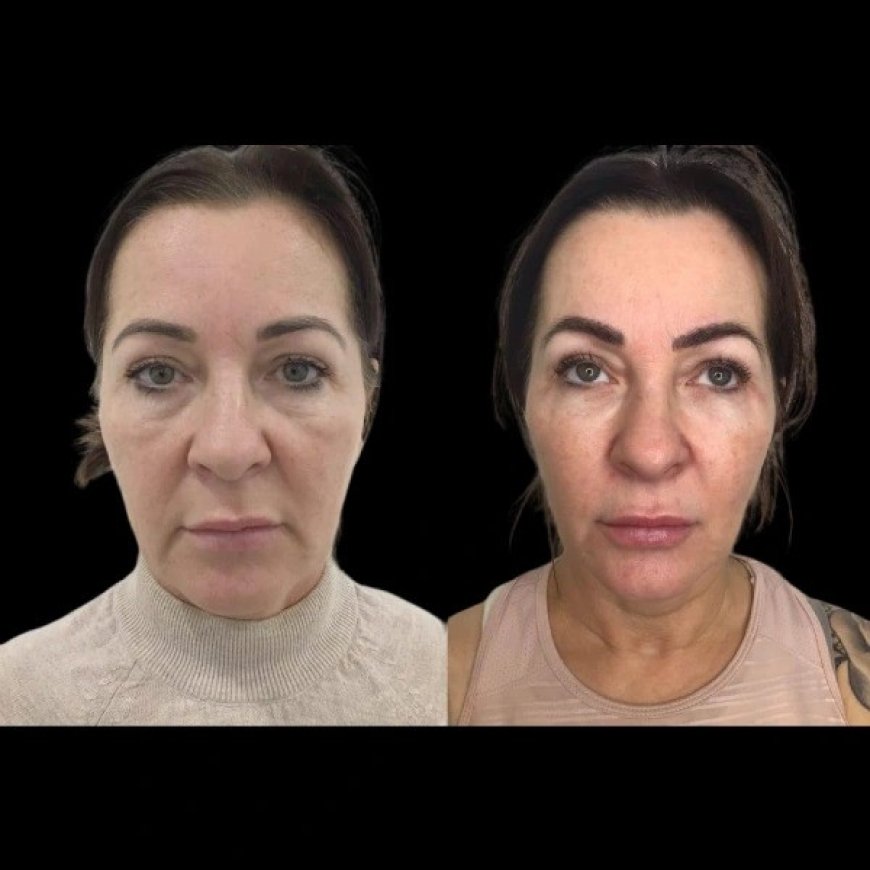 Best Plastic Surgeon in Dubai for Profhilo: Cost, Benefits, and Results Explained